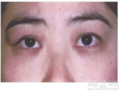 泪腺炎症状,揭秘眼部不适的信号